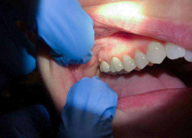 Best Urgent Care for Lost Fillings or Crowns in Grosse Pointe, MI